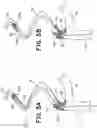 Fig. 08 - Floating carotid filter