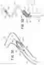 Fig. 09 - Floating carotid filter