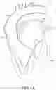Fig. 02 - Adjustable endolumenal implant for reshaping the mitral valve annulus