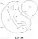 Fig. 03 - Adjustable endolumenal implant for reshaping the mitral valve annulus