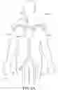 Fig. 04 - Adjustable endolumenal implant for reshaping the mitral valve annulus