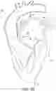 Fig. 05 - Adjustable endolumenal implant for reshaping the mitral valve annulus
