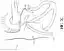 Fig. 06 - Adjustable endolumenal implant for reshaping the mitral valve annulus