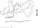 Fig. 07 - Adjustable endolumenal implant for reshaping the mitral valve annulus