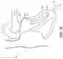 Fig. 08 - Adjustable endolumenal implant for reshaping the mitral valve annulus