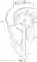 Fig. 09 - Adjustable endolumenal implant for reshaping the mitral valve annulus
