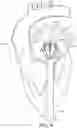 Fig. 10 - Adjustable endolumenal implant for reshaping the mitral valve annulus