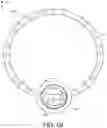 Fig. 14 - Adjustable endolumenal implant for reshaping the mitral valve annulus