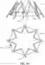 Fig. 17 - Adjustable endolumenal implant for reshaping the mitral valve annulus