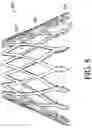 Fig. 25 - Adjustable endolumenal implant for reshaping the mitral valve annulus