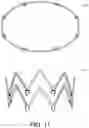 Fig. 28 - Adjustable endolumenal implant for reshaping the mitral valve annulus