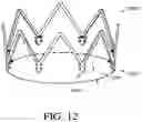 Fig. 29 - Adjustable endolumenal implant for reshaping the mitral valve annulus