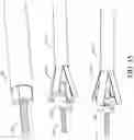 Fig. 32 - Adjustable endolumenal implant for reshaping the mitral valve annulus