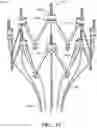 Fig. 37 - Adjustable endolumenal implant for reshaping the mitral valve annulus