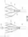 Fig. 41 - Adjustable endolumenal implant for reshaping the mitral valve annulus