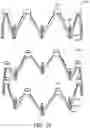 Fig. 50 - Adjustable endolumenal implant for reshaping the mitral valve annulus