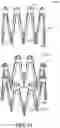 Fig. 52 - Adjustable endolumenal implant for reshaping the mitral valve annulus