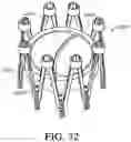 Fig. 53 - Adjustable endolumenal implant for reshaping the mitral valve annulus