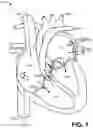 Fig. 02 - Trileaflet mechanical prosthetic heart valve