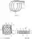 Fig. 03 - Tension member routing elements in transcatheter stented prosthesis tensioning system