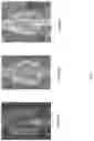 Fig. 08 - Compression resistant implants including an oxysterol and methods of use