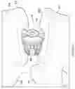 Fig. 15 - Rotatable intervertebral spacing implant
