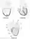 Fig. 03 - Horseshoe-shaped guide catheter and procedure for ductus arteriosus angioplasty in newborn and infant patients