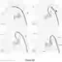 Fig. 07 - Horseshoe-shaped guide catheter and procedure for ductus arteriosus angioplasty in newborn and infant patients