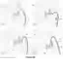 Fig. 08 - Horseshoe-shaped guide catheter and procedure for ductus arteriosus angioplasty in newborn and infant patients
