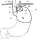 Fig. 01 - Methods and instruments for treating GERD and hiatal hernia