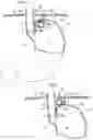 Fig. 04 - Methods and instruments for treating GERD and hiatal hernia
