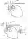 Fig. 07 - Methods and instruments for treating GERD and hiatal hernia