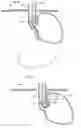 Fig. 23 - Methods and instruments for treating GERD and hiatal hernia