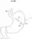 Fig. 28 - Methods and instruments for treating GERD and hiatal hernia