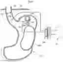 Fig. 33 - Methods and instruments for treating GERD and hiatal hernia