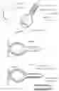 Fig. 35 - Methods and instruments for treating GERD and hiatal hernia