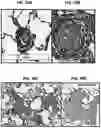 Fig. 49 - Methods for treatment using small molecule potassium-sparing diuretics and natriuretics