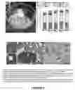 Fig. 03 - DETECTION OF METASTATIC DISEASE AND RELATED METHODS