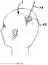 Fig. 06 - METHODS FOR DISTRIBUTING AGENTS TO AREAS OF BRAIN
