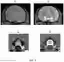 Fig. 08 - METHODS FOR DISTRIBUTING AGENTS TO AREAS OF BRAIN