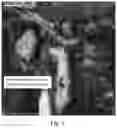 Fig. 02 - Settable bone void filler