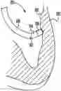 Fig. 01 - Catheter with pressure measuring tip