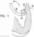 Fig. 02 - Catheter with pressure measuring tip