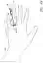 Fig. 14 - Securement device having an integral strap and dressing