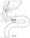 Fig. 06 - DELIVERY SYSTEMS FOR DEVICES WITH UNSUPPORTED STRUCTURE