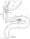 Fig. 07 - DELIVERY SYSTEMS FOR DEVICES WITH UNSUPPORTED STRUCTURE