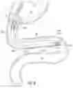 Fig. 08 - DELIVERY SYSTEMS FOR DEVICES WITH UNSUPPORTED STRUCTURE