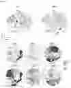 Fig. 04 - Bioengineered in vitro 3D model of human atherosclerotic plaque