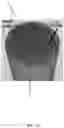 Fig. 05 - Microsphere based patterning of metal optic/plasmonic sensors including fiber based sensors
