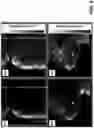 Fig. 09 - Assessment of arterial calcifications